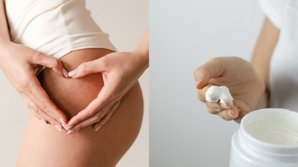 Como eu acabei de vez com minhas estrias (e você também pode!)